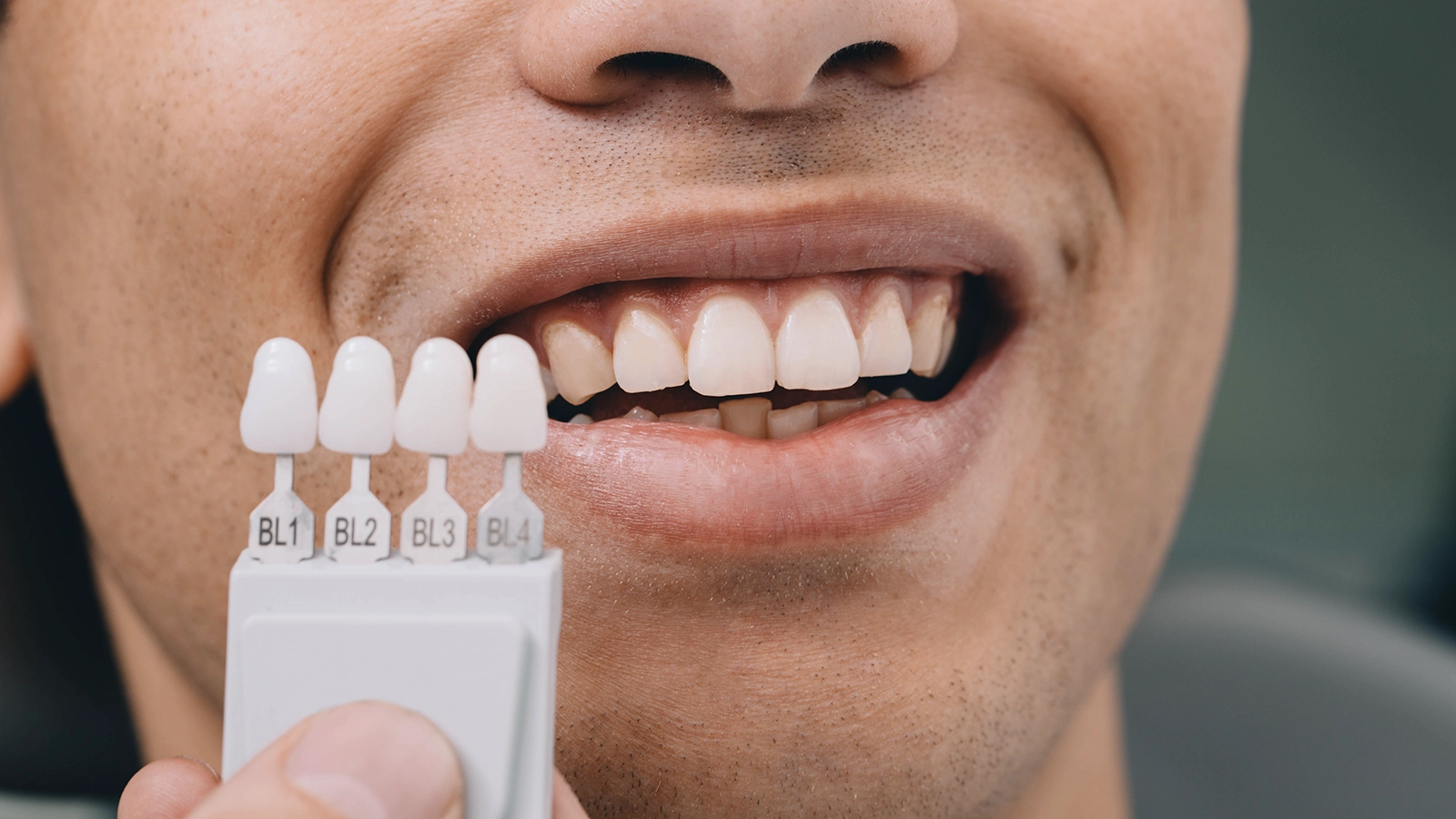 E-max and zirconia veneer price comparison for Turkey dental treatment